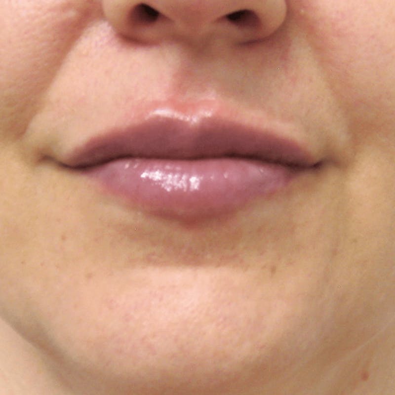 Fillers Before & After Gallery - Patient 132985829 - Image 4
