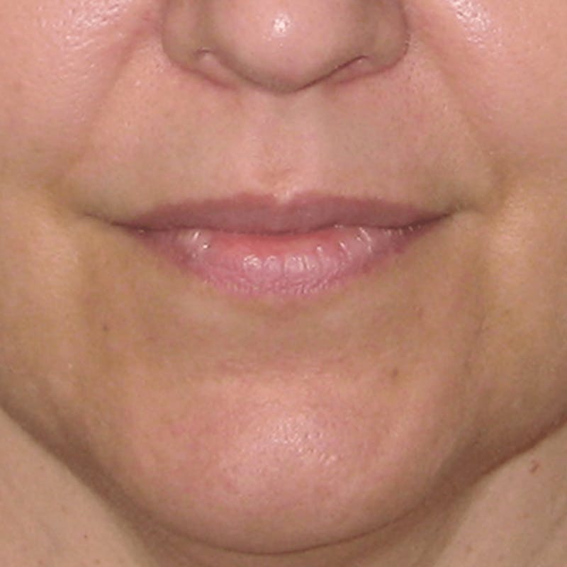 Fillers Before & After Gallery - Patient 132985829 - Image 3