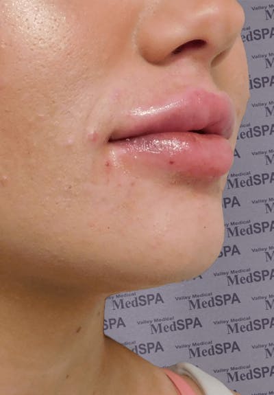 Fillers Before & After Gallery - Patient 132985831 - Image 2