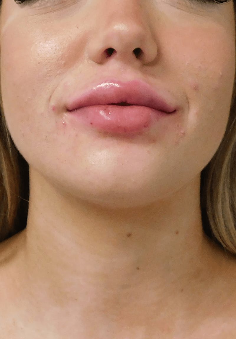 Fillers Before & After Gallery - Patient 132985831 - Image 4