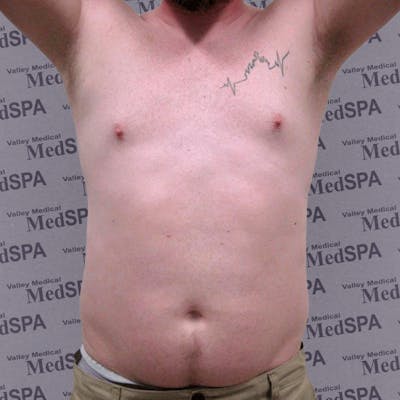 Laser Lipo Before & After Gallery - Patient 132985962 - Image 2