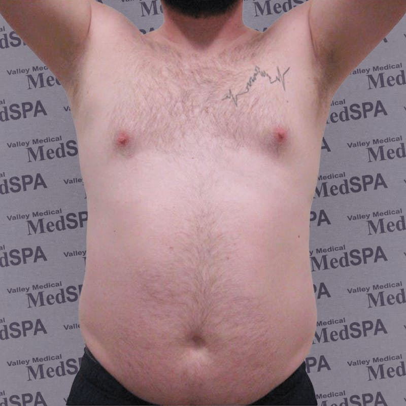 Laser Lipo Before & After Gallery - Patient 132985962 - Image 1