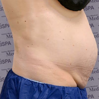 Laser Lipo Before & After Gallery - Patient 132985963 - Image 1