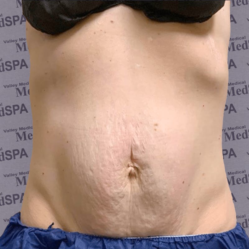 Laser Lipo Before & After Gallery - Patient 132985963 - Image 4