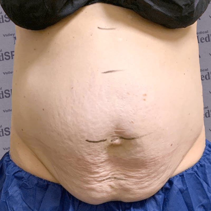 Laser Lipo Before & After Gallery - Patient 132985963 - Image 3