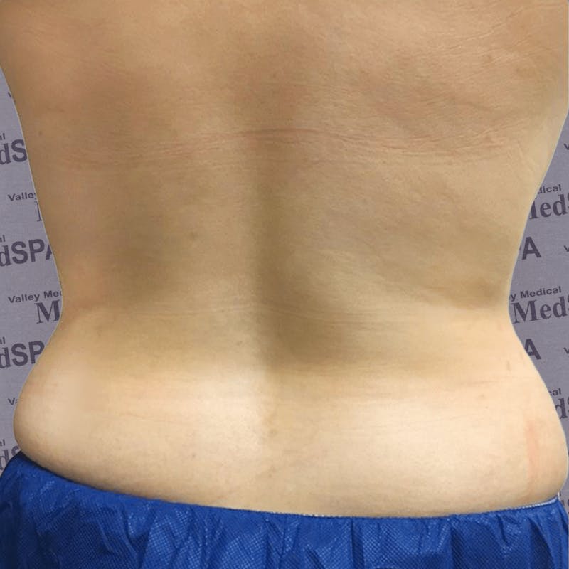 Laser Lipo Before & After Gallery - Patient 132985964 - Image 2