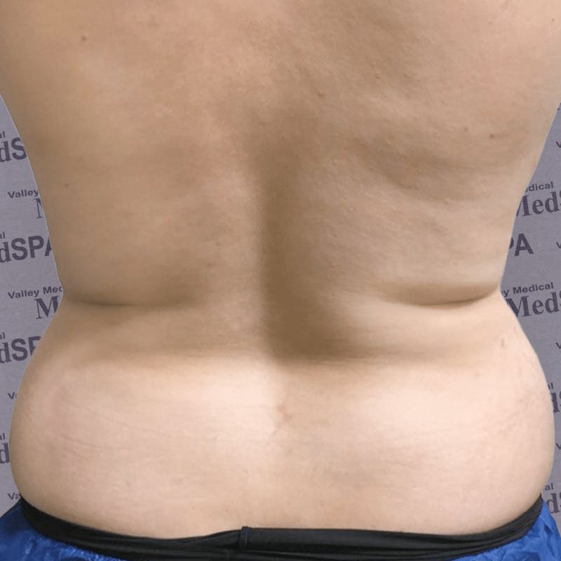 Laser Lipo Before & After Gallery - Patient 132985964 - Image 1