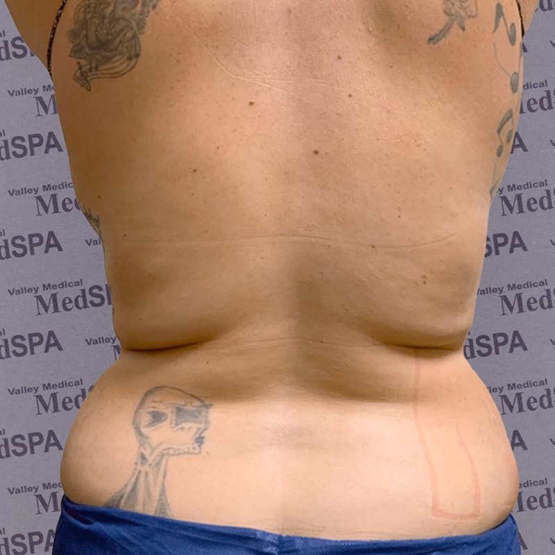 Laser Lipo Before & After Gallery - Patient 132985965 - Image 2