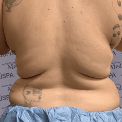 Laser Lipo Before & After Gallery - Patient 132985965 - Image 1