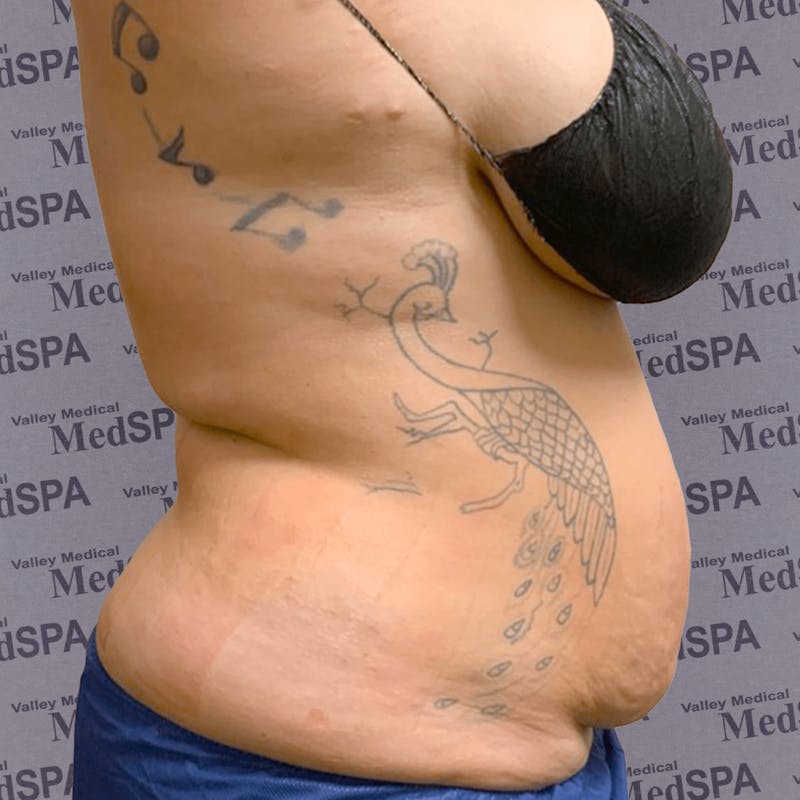 Laser Lipo Before & After Gallery - Patient 132985965 - Image 4