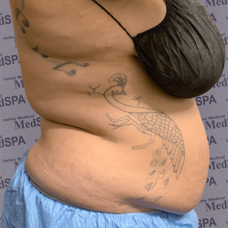 Laser Lipo Before & After Gallery - Patient 132985965 - Image 3