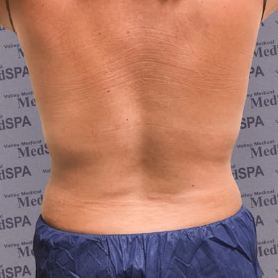 Laser Lipo Before & After Gallery - Patient 132985966 - Image 2