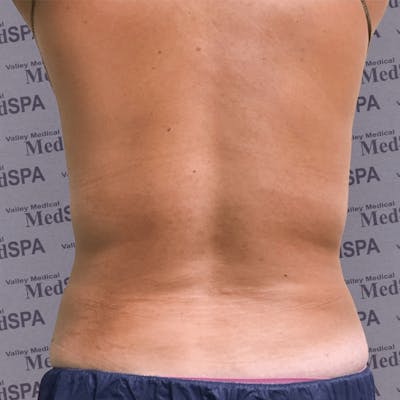 Laser Lipo Before & After Gallery - Patient 132985966 - Image 1