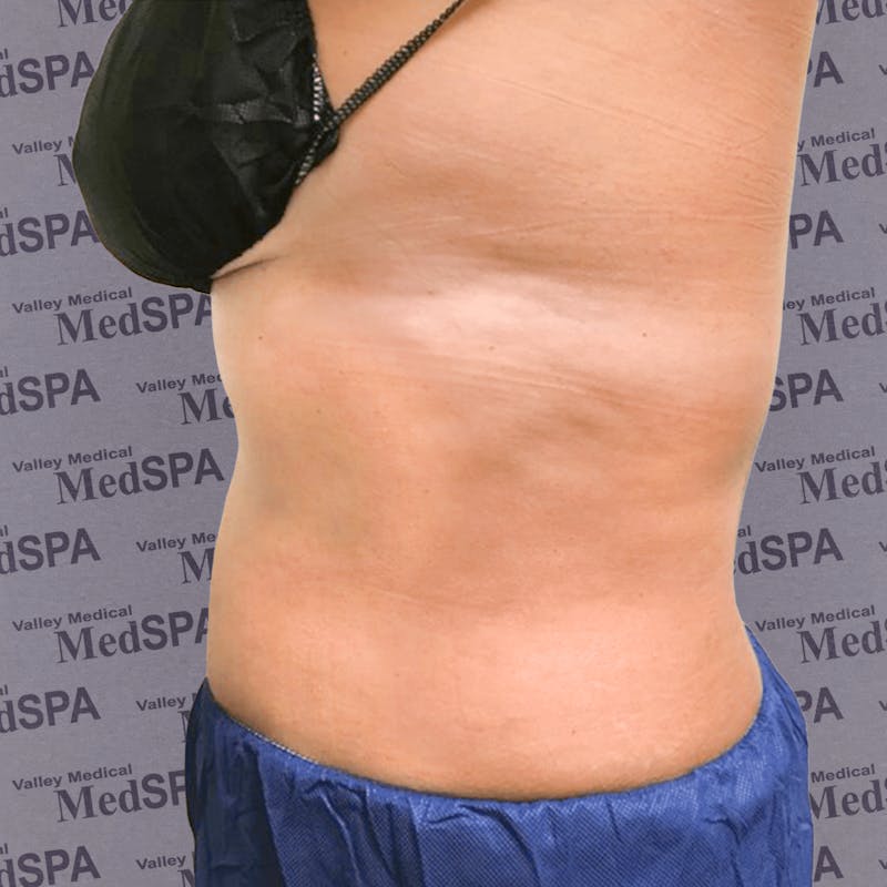 Laser Lipo Before & After Gallery - Patient 132985966 - Image 4