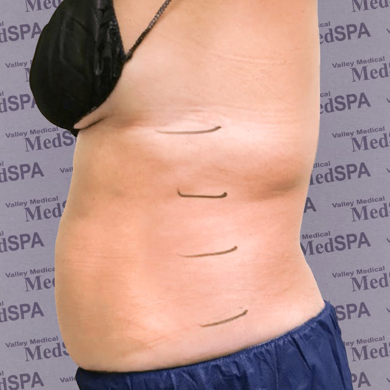Laser Lipo Before & After Gallery - Patient 132985966 - Image 3