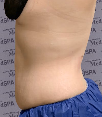 Laser Lipo Before & After Gallery - Patient 132985967 - Image 2