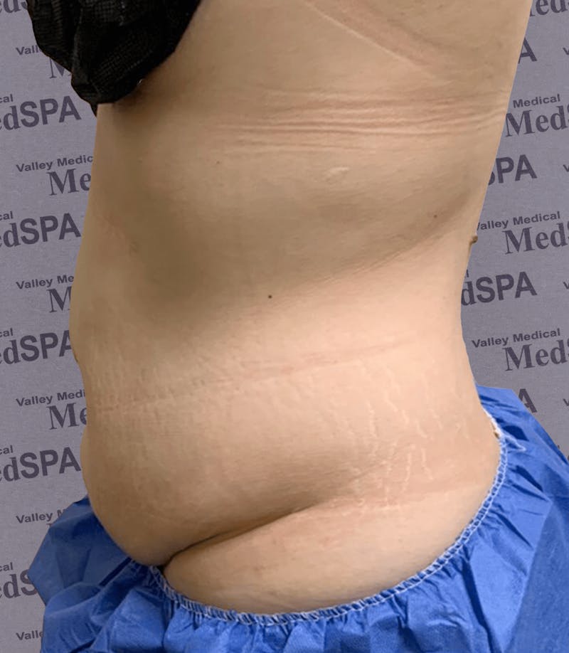 Laser Lipo Before & After Gallery - Patient 132985967 - Image 1