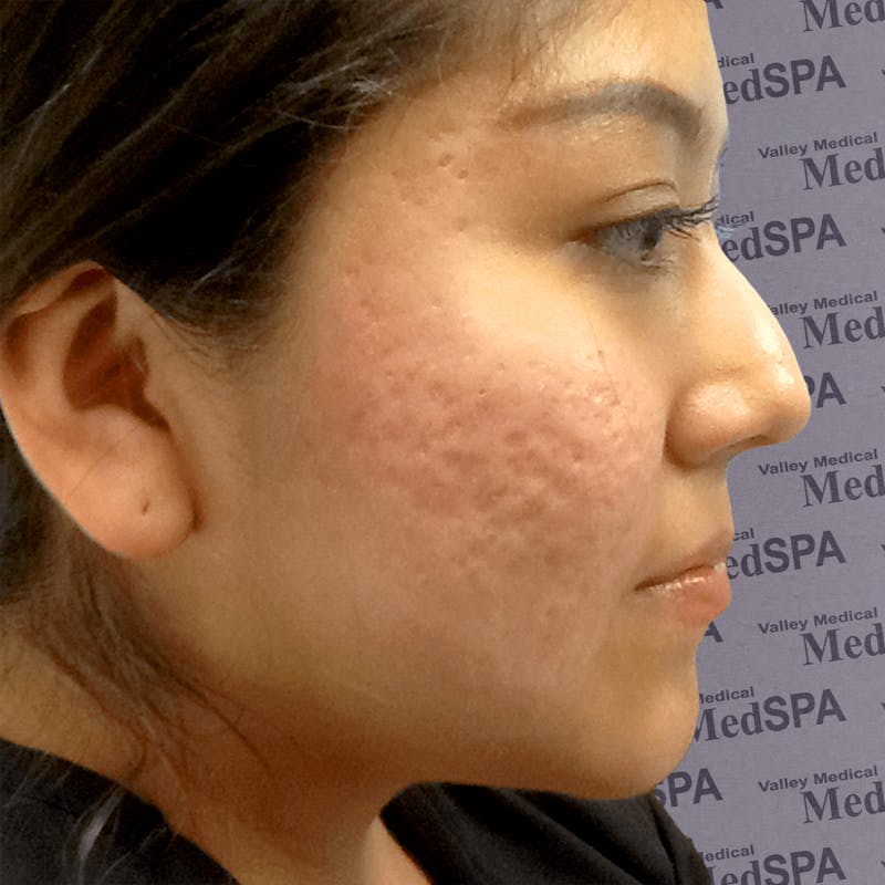 PRP for Acne Scarring Before & After Gallery - Patient 132985984 - Image 1