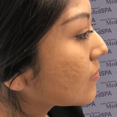 PRP for Acne Scarring Before & After Gallery - Patient 132985984 - Image 2