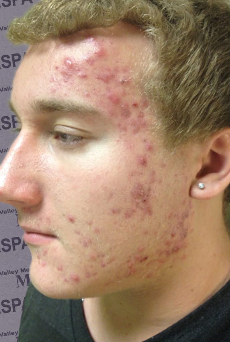 PRP for Acne Scarring Before & After Gallery - Patient 132985985 - Image 2