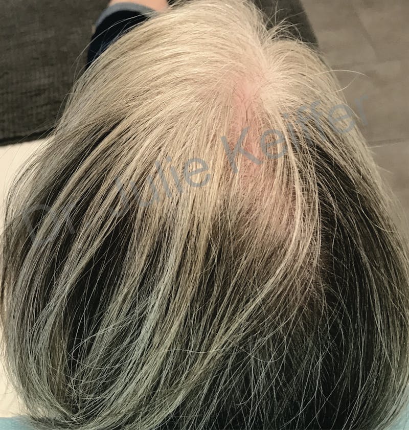 PRP for Hair Loss Before & After Gallery - Patient 132985990 - Image 1