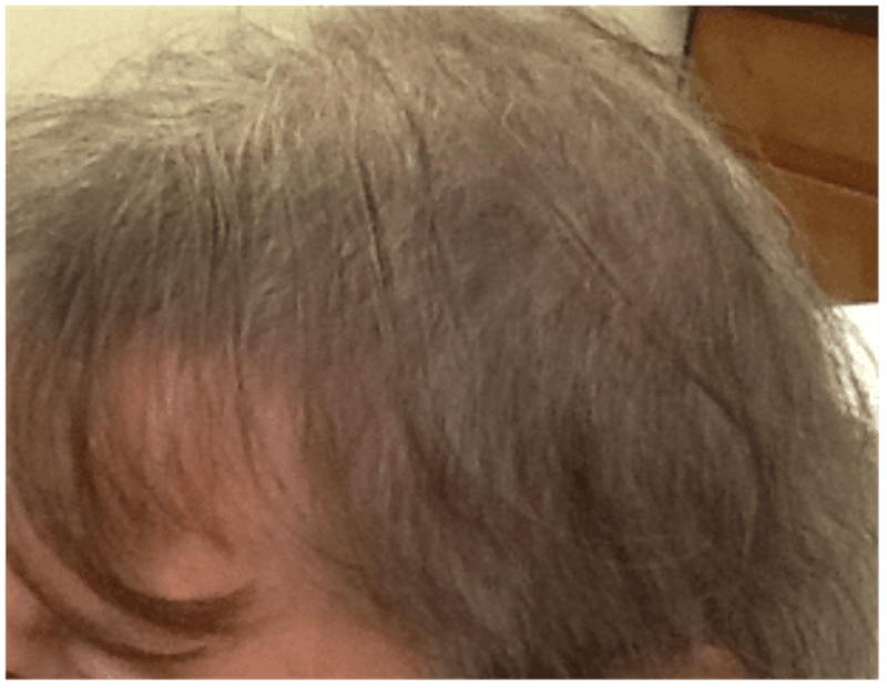 PRP for Hair Loss Before & After Gallery - Patient 132985991 - Image 2