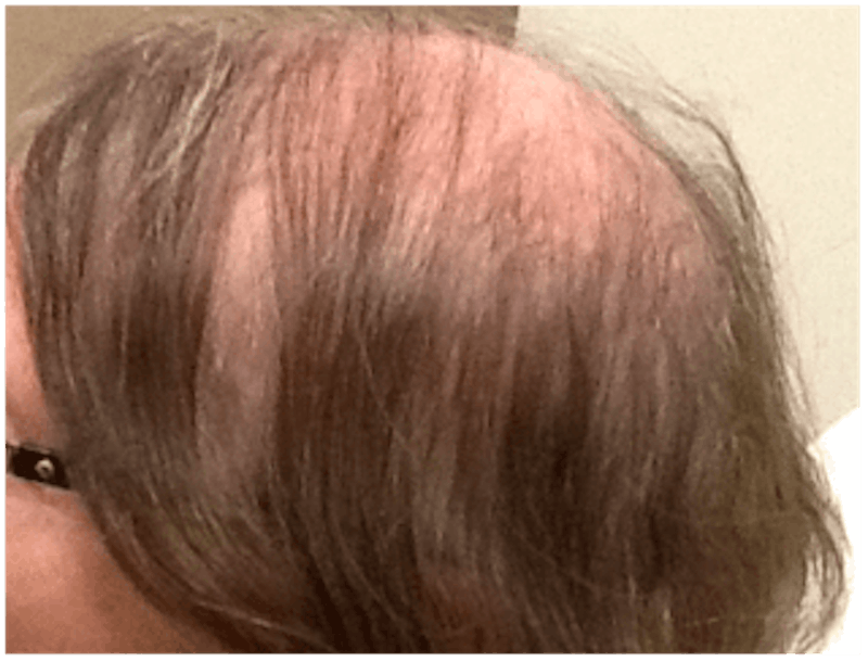 PRP for Hair Loss Before & After Gallery - Patient 132985991 - Image 1