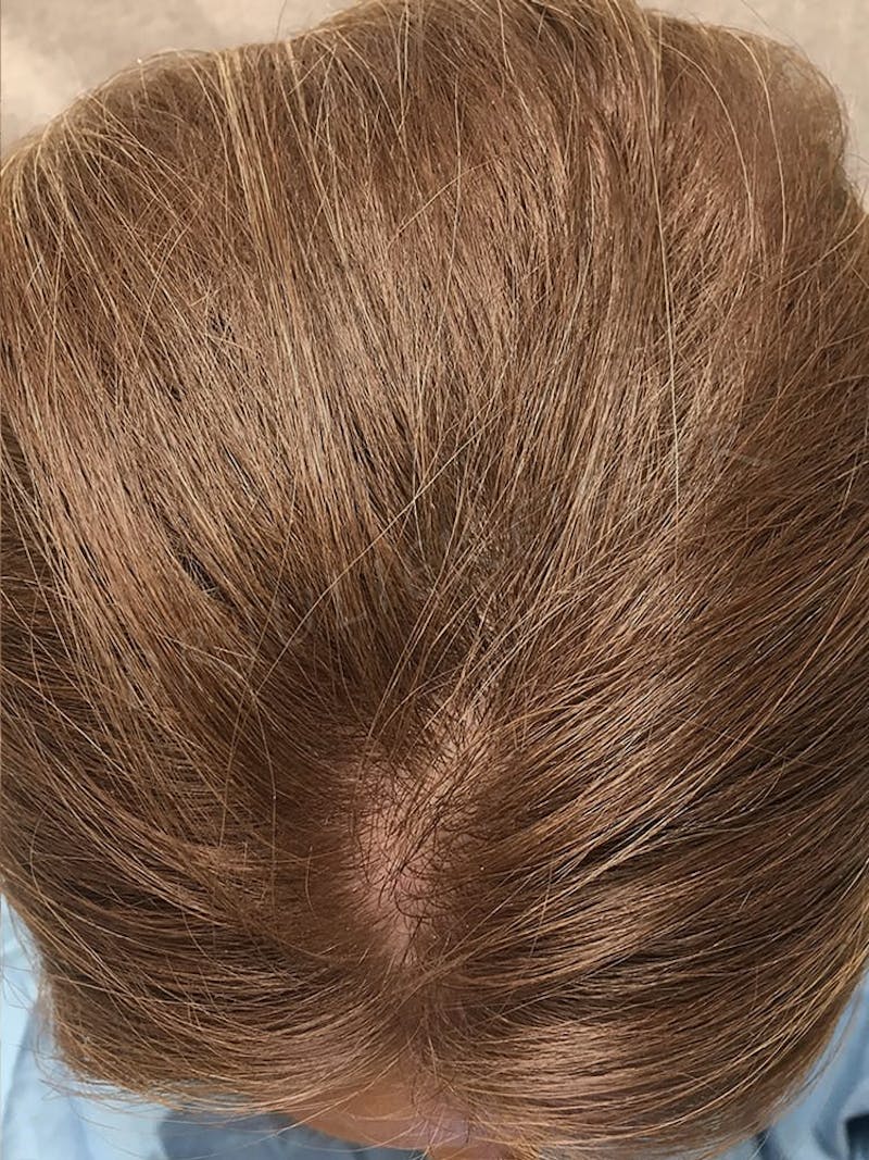 PRP for Hair Loss Before & After Gallery - Patient 132985992 - Image 2