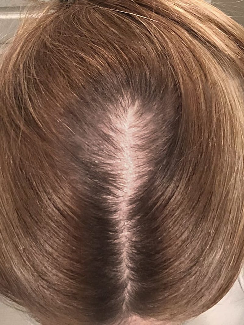PRP for Hair Loss Before & After Gallery - Patient 132985992 - Image 1