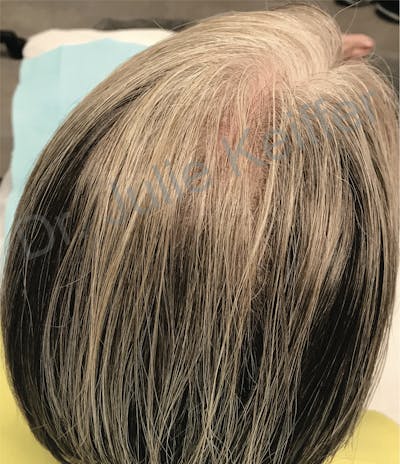 PRP for Hair Loss Before & After Gallery - Patient 132985990 - Image 2