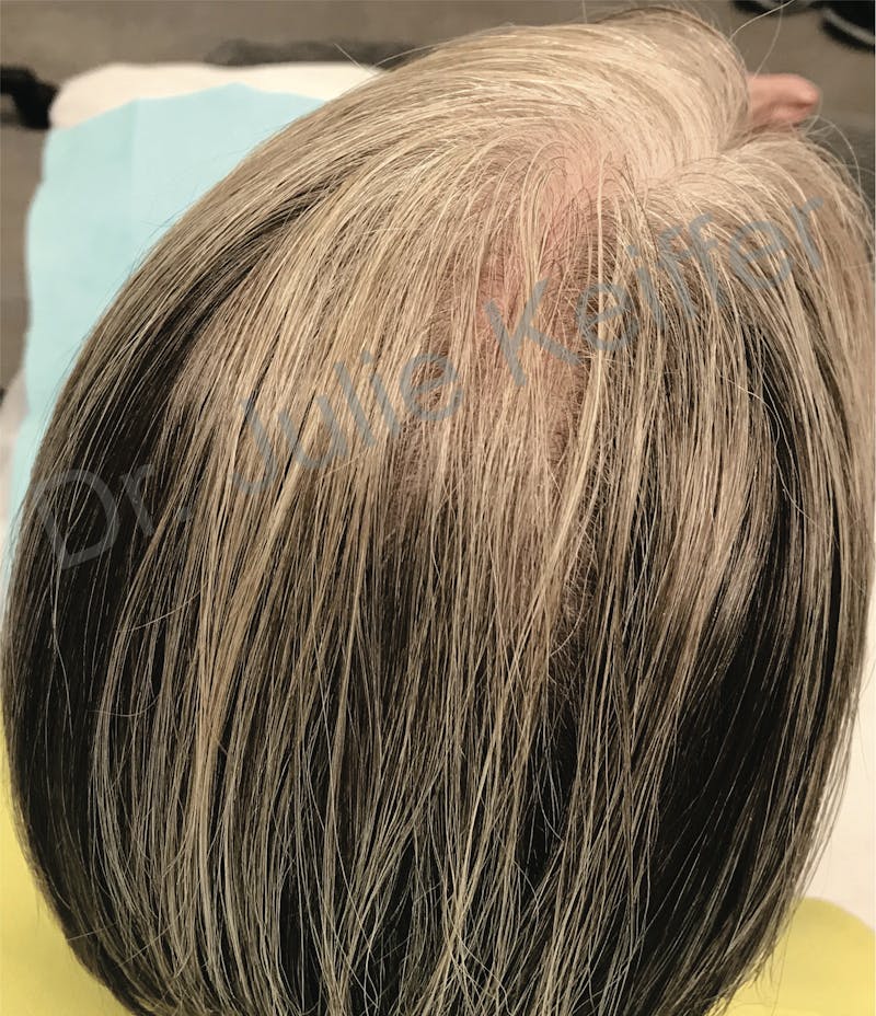 PRP for Hair Loss Before & After Gallery - Patient 132985990 - Image 2