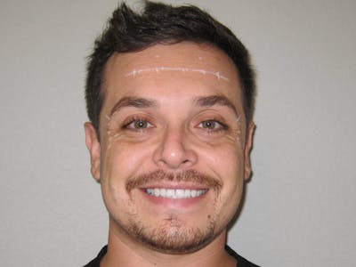 BOTOX Before & After Gallery - Patient 127577235 - Image 1