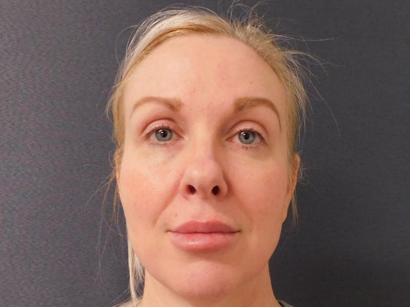 Fillers Before & After Gallery - Patient 127577221 - Image 2