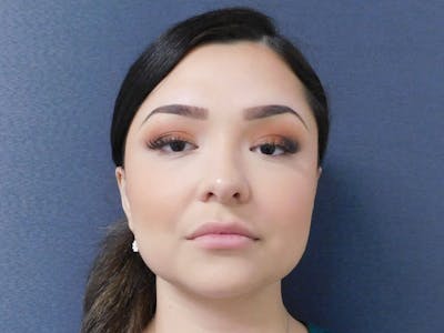 Fillers Before & After Gallery - Patient 127577222 - Image 1