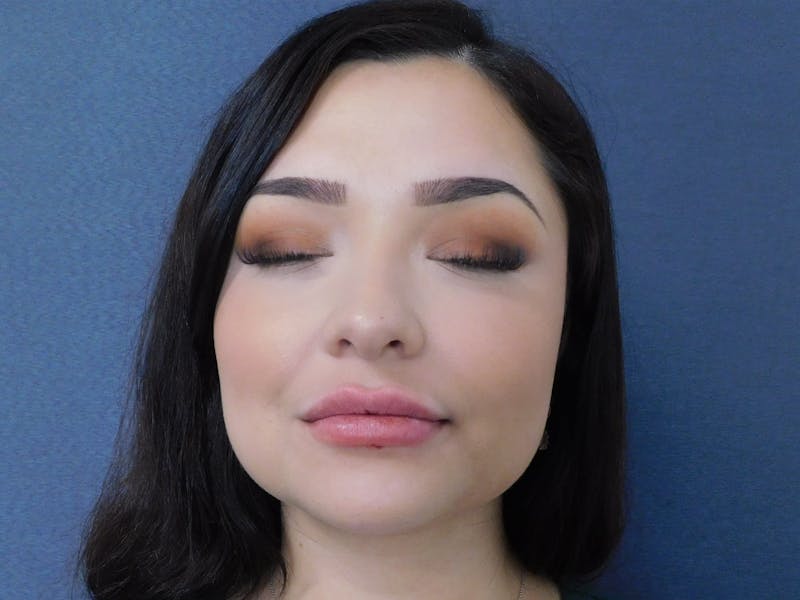 Fillers Before & After Gallery - Patient 127577222 - Image 2