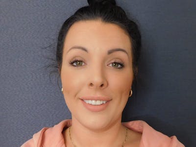 Fillers Before & After Gallery - Patient 127577240 - Image 2