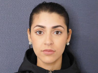 Fillers Before & After Gallery - Patient 127577241 - Image 2