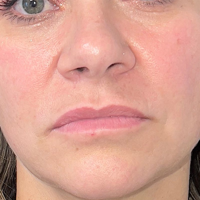 Fillers Before & After Gallery - Patient 278713 - Image 1