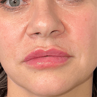 Fillers Before & After Gallery - Patient 278713 - Image 2