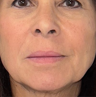 Fillers Before & After Gallery - Patient 293075 - Image 1