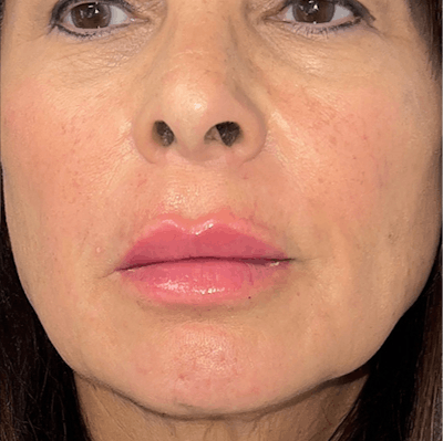 Fillers Before & After Gallery - Patient 293075 - Image 2