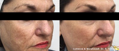 Lumecca IPL Before & After Gallery - Patient 374104 - Image 1