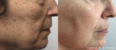 Lumecca IPL Before & After Gallery - Patient 355782 - Image 1