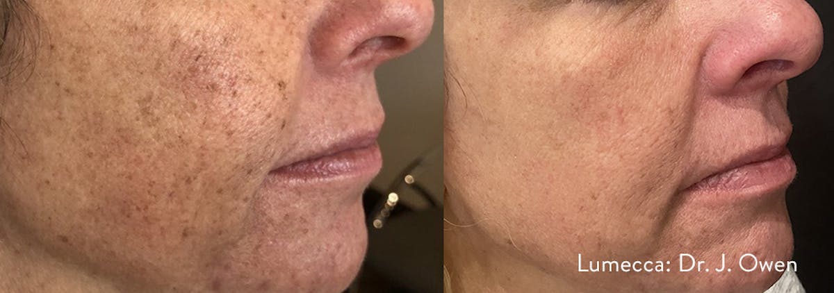 Lumecca IPL Before & After Gallery - Patient 896277 - Image 1