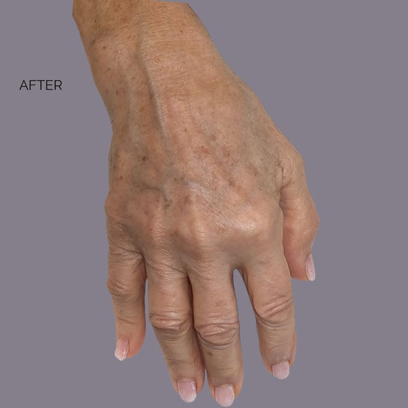 Bellafill Before & After Gallery - Patient 389039 - Image 2