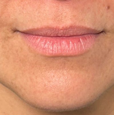 Fillers Before & After Gallery - Patient 392873 - Image 1