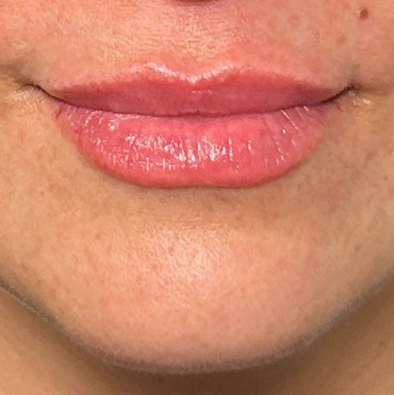 Fillers Before & After Gallery - Patient 392873 - Image 2