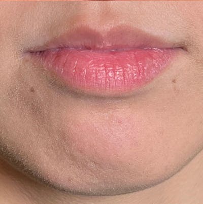 Fillers Before & After Gallery - Patient 171792 - Image 1