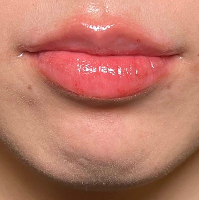 Fillers Before & After Gallery - Patient 171792 - Image 2