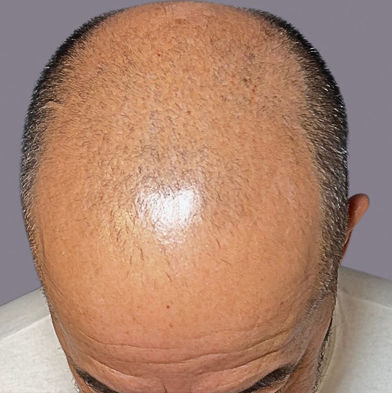 PRP for Hair Loss Before & After Gallery - Patient 221780 - Image 1